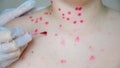 Ãâoctor to treat rash with chicken pox