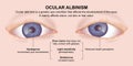 Ocular Albinism Patient Education Flashcard Royalty Free Stock Photo