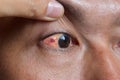 Ocular larva migrans or dilated vessels in the eye of Asian man