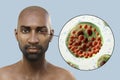 Ocular rhinosporidiosis in a patient, 3D illustration. A disease caused by Rhinosporidium seeberi parasite