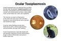 Ocular toxoplasmosis, retinal scar caused by a Toxoplasma gondii infection, scientific illustration