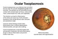 Ocular toxoplasmosis, retinal scar caused by a Toxoplasma gondii infection, scientific illustration