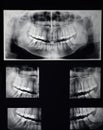 Odontostomalogical radiographs, digital orthopantomography for dental diagnosis