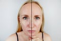 Oily skin and clear skin. Two photos before and after. Portrait of a girl with problem skin Royalty Free Stock Photo