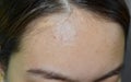 Oily skin with wide forehead of Asian adult young woman