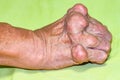 Old age and illnesses of pharmaceutical medicament severe gout in men suffering from joint pain, bone pain, gout ,arthritis ,arm,