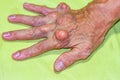 Old age and illnesses of pharmaceutical medicament severe gout in men suffering from joint pain, bone pain, gout ,arthritis ,arm,