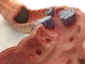 Old anatomical model of Colon with examples of different diseases Royalty Free Stock Photo