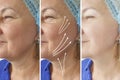 Old caucasian woman wrinkles tightening arrow correction before after lifting plastic filler rejuvenation