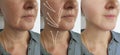 Old caucasian woman wrinkles correction before and after lifting plastic filler rejuvenation