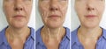 Old caucasian woman wrinkles before and after lifting plastic filler rejuvenation