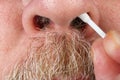 Old elderly allergenic man cleans his nose with a cotton swab macro