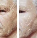 Old man face effect wrinkles treatment arrow before and after procedures therapy medicine Royalty Free Stock Photo