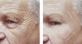 Old man face effect wrinkles removal arrow before and after procedures therapy medicine Royalty Free Stock Photo