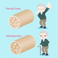 Old man with osteoporosis
