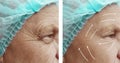 Old man with wrinkles on face results cosmetology before and after procedures arrow