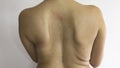 Old operation scar on the back of a young woman. Operated back. Spine surgery. Scoliosis of the spine.
