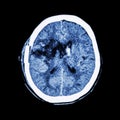 Old right basal ganglia hemorrhage with brain edema ( status post craniotomy ) ( Hemorrhagic stroke ) Royalty Free Stock Photo