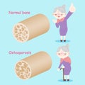 Old woman with osteoporosis