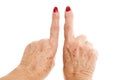 Old Woman`s Hands Deformed From Rheumatoid Arthritis