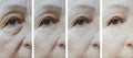 Old woman wrinkles eyes before and after result correction treatment Royalty Free Stock Photo