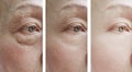 Old woman wrinkles eyes before and after treatment Royalty Free Stock Photo