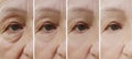 Old woman wrinkles eyes before and after circles result correction treatment Royalty Free Stock Photo