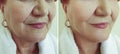Old woman wrinkles face liftbefore and effect correction after treatment