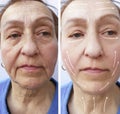 Old woman wrinkles before and after filler hydrating the procedure