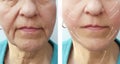 Old woman wrinkles patient before and after filler hydrating the procedure