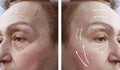 Old woman wrinkles patient before and after plastic filler hydrating the procedure effect