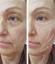Old woman wrinkles before and after plastic filler hydrating the procedure effect