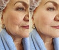 Old woman wrinkles removalface lift beautician before and effect correction after treatment