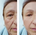 Old woman wrinkles before and after medicine correction cosmetology treatments Royalty Free Stock Photo