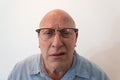 Older man bewildered with horn rimmed glasses, bald, alopecia, chemotherapy, cancer