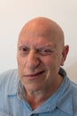 Older man half grin, bald, alopecia, chemotherapy, cancer