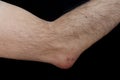 Olecranon bursitis, also known as studentÃ¢â¬â¢s elbow