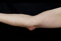 Olecranon bursitis, also known as studentÃ¢â¬â¢s elbow