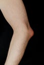 Olecranon bursitis, also known as studentÃ¢â¬â¢s elbow