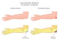 Olecranon bursitis or student's elbow