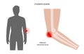 Student elbow bursitis