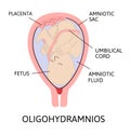 Oligohydramnios, deficiency of amniotic fluid. Parts of pregnancy are marked with line Royalty Free Stock Photo