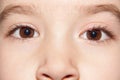 One eye infection stye - upper eyelid inflammation