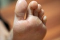 one foot the skin detaches due to eczema