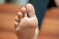 one foot the skin detaches due to eczema