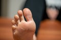 one foot the skin detaches due to eczema