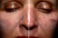 One half of the face in pigmentation and brown spots, the other side of the face after laser polishing and peeling Royalty Free Stock Photo