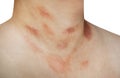 One person with Pityriasis rosea disease on the chest and neck Royalty Free Stock Photo