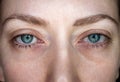 ÃÂ¡onjunctivitis. Pinkeye. Woman`s eye. Eye disease. Closed up