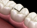 Onlay ceramic crown fixation over tooth. Medically accurate 3D illustration of human teeth Royalty Free Stock Photo